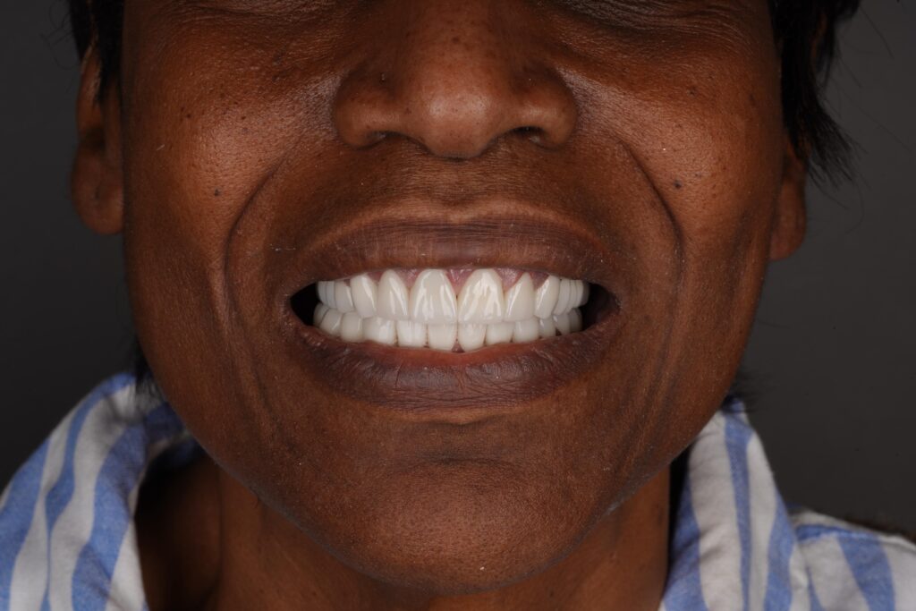 hollywood smile